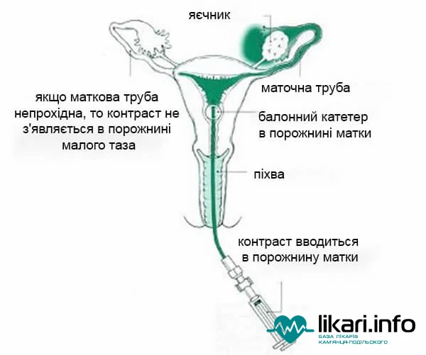 МРТ маткових труб – безпечний метод діагностики жіночого здоров’я