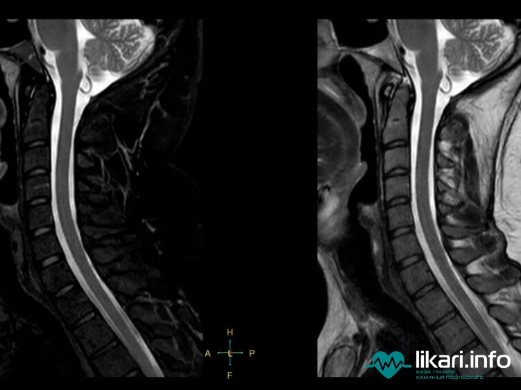МРТ шийного відділу хребта | MRI of the Cervical Spine
