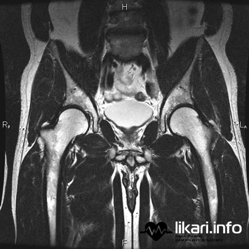 МРТ кульшового суглоба | MRI of the Hip Joint