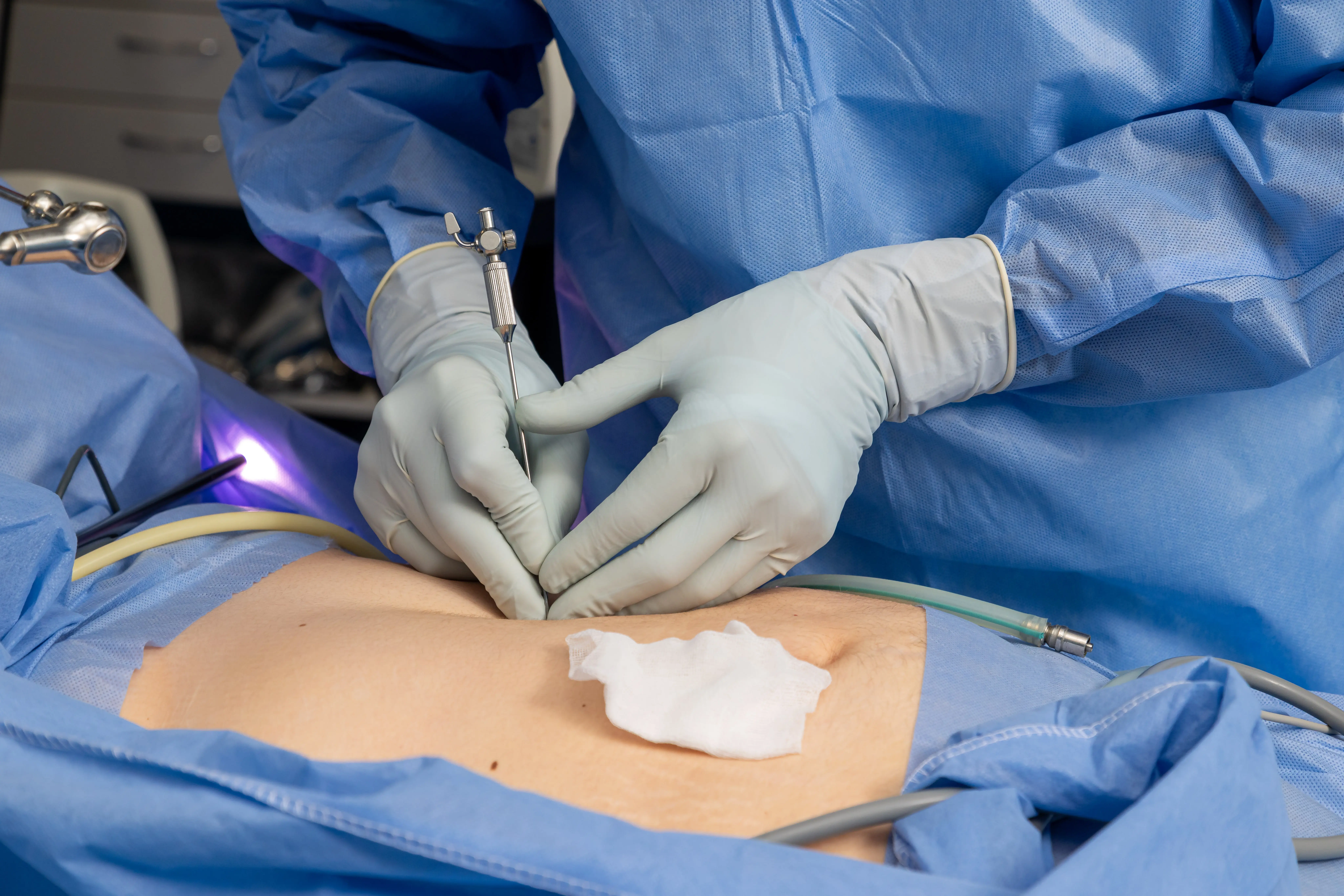 Баріатрична операція, яку проводить хірург — Емір-Усеїнов Таїр