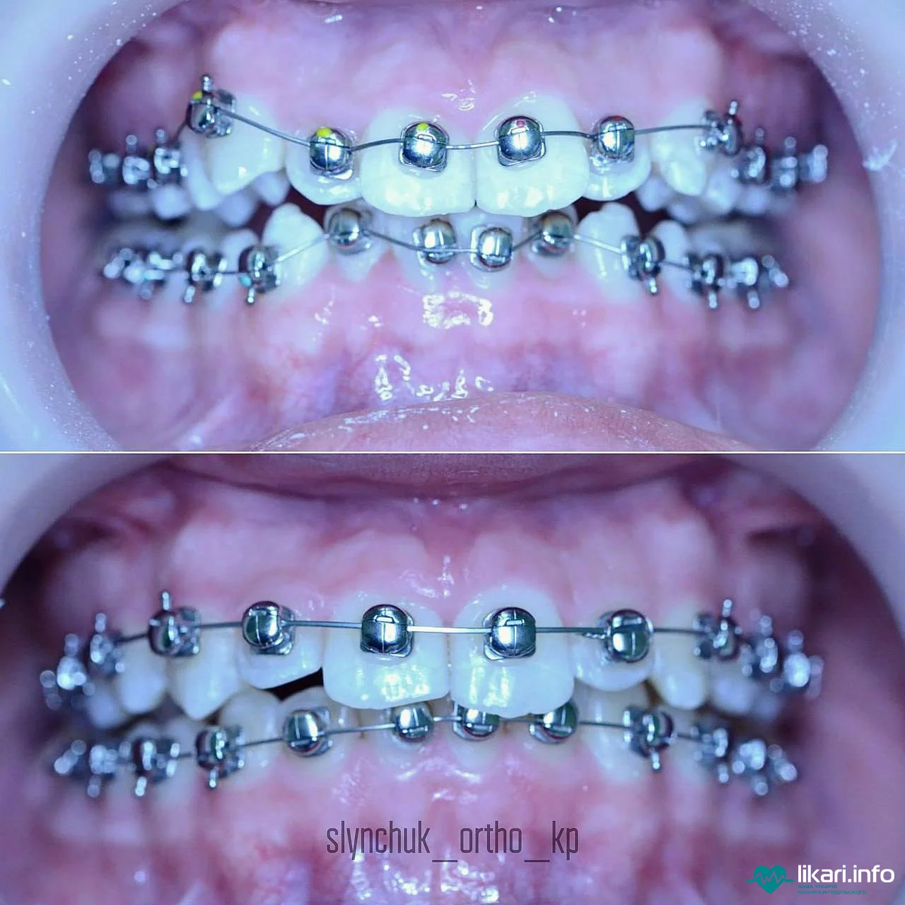 Ортодонтичне лікування фото 1